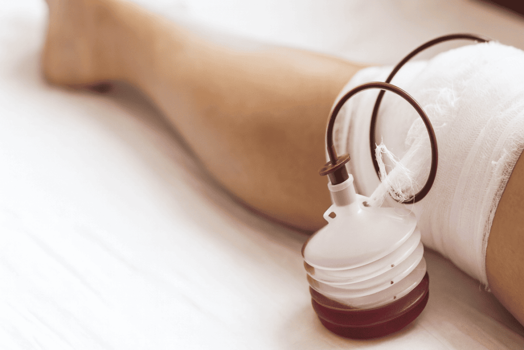 Drenajes Quirúrgicos, Manejo de catéter venoso central, asegurando su correcto funcionamiento, Curaciones a Domicilio con MAQMUN Médica. Atención profesion